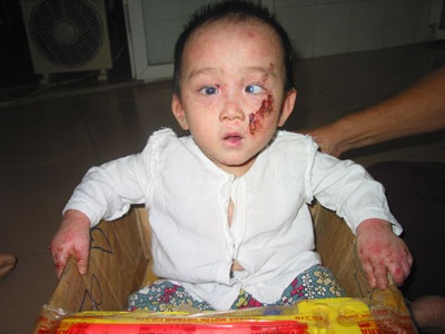 Bệnh nhân thứ 3 được ghép tế bào gốc từ tủy xương điều trị bệnh “lột da ếch” - 2 Bệnh nhân thứ 3 được ghép tế bào gốc từ tủy xương điều trị bệnh “lột da ếch”