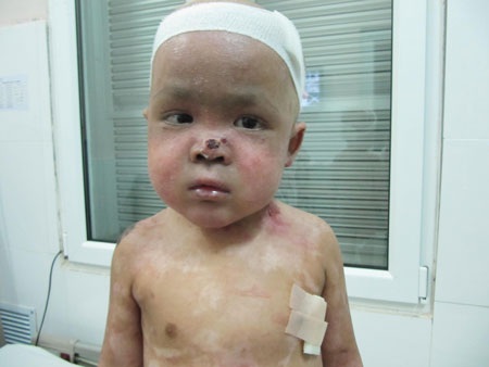 Bệnh nhân thứ 3 được ghép tế bào gốc từ tủy xương điều trị bệnh “lột da ếch” - 1 Bệnh nhân thứ 3 được ghép tế bào gốc từ tủy xương điều trị bệnh “lột da ếch”