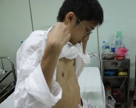 Bệnh nhân phẫu thuật bệnh lõm ngực bẩm sinh tăng đột biến dịp hè - 1 Bệnh nhân phẫu thuật bệnh lõm ngực bẩm sinh tăng đột biến dịp hè