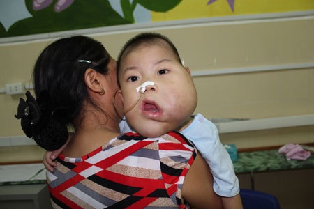 Bé Trần Hải Quân sẽ được phẫu thuật trong tuần tới để lấy sạch khối u còn lại ở vùng má trái