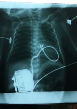 và sau khi được cấy máy tạo nhịp tim