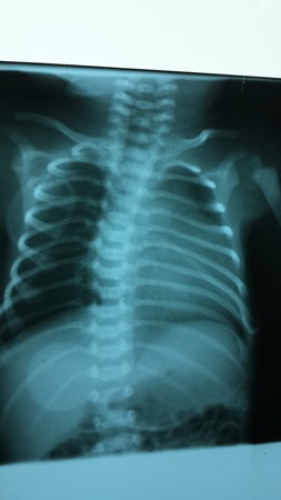 Hình ảnh siêu âm của bé Duyệt trước khi phẫu thuật