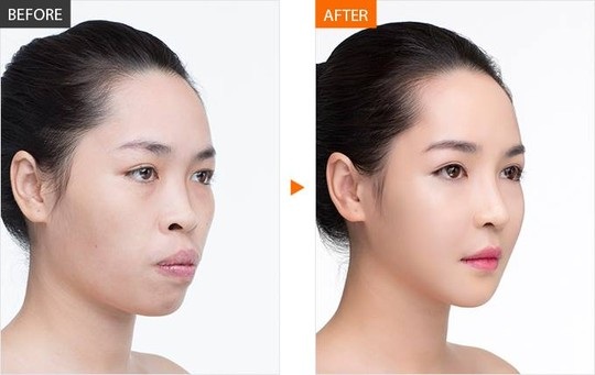 Cuộc đổi đời của cô gái xinh đẹp nhờ phẫu thuật thẩm mỹ - 2
Hình ảnh của Quỳnh trước và sau khi được phẫu thuật