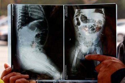 Kinh hoàng phát hiện 12 chiếc kim trong người bé gái Trung Quốc - 1 Những chiếc kim bên trong cơ thể bé gái.