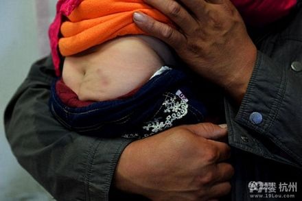 Kinh hoàng phát hiện 12 chiếc kim trong người bé gái Trung Quốc - 2 Vết tấy đỏ trên mông bé gái.