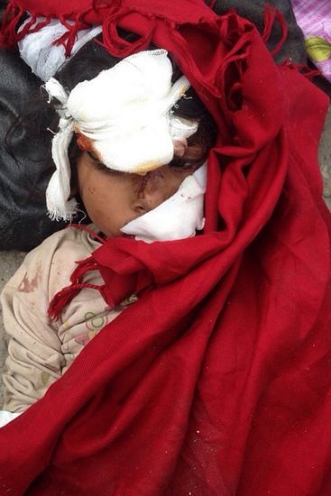 Một bé gái bị băng bó kín mặt do bị thương trong động đất.