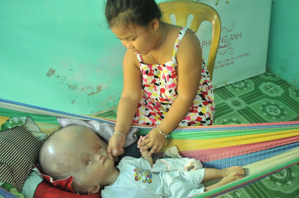 Khốn khổ cuộc sống của bé 14 tháng tuổi có đầu to gấp bốn lần cơ thể - 4 Cháu Anh Thi mong cha và ông bà ngoại có tiền để đưa em Đạt đi chữa bệnh