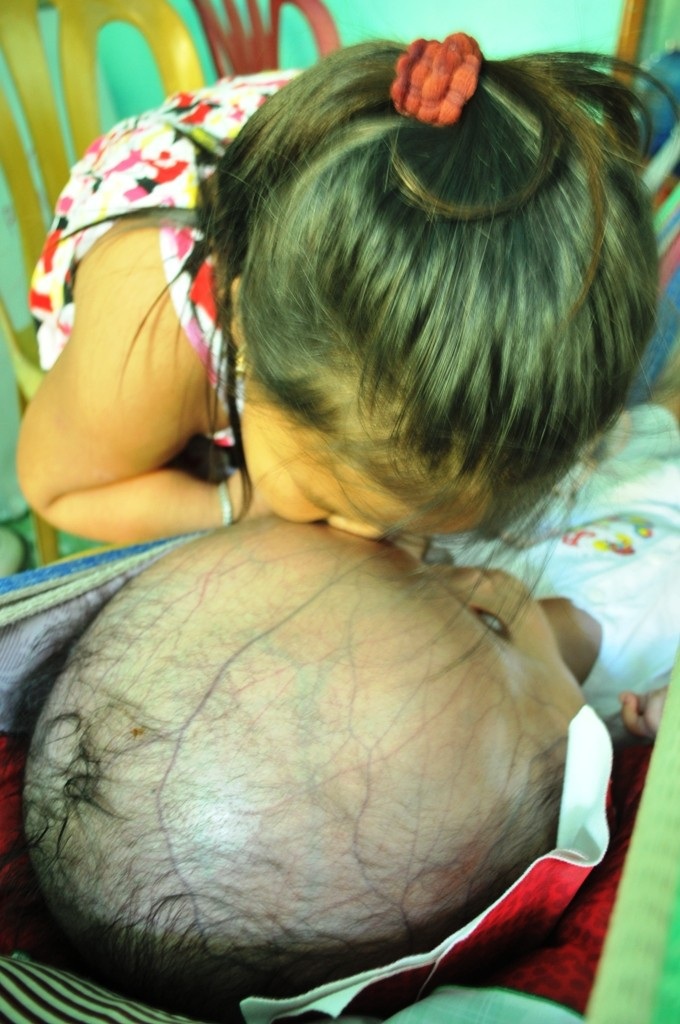 Khốn khổ cuộc sống của bé 14 tháng tuổi có đầu to gấp bốn lần cơ thể - 5 Cháu Anh Thi mong cha và ông bà ngoại có tiền để đưa em Đạt đi chữa bệnh