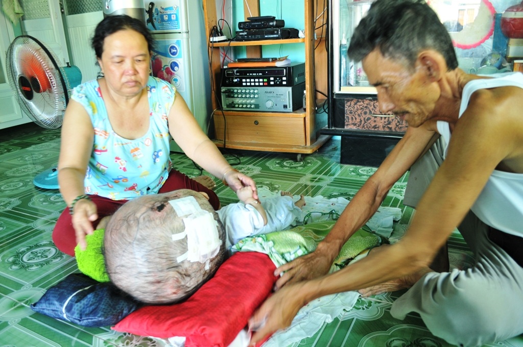 Khốn khổ cuộc sống của bé 14 tháng tuổi có đầu to gấp bốn lần cơ thể - 2 Từ ngày mang bé Đạt về nuôi, vợ chồng ông Quân bỏ hết mọi việc, tập trung vào việc chăm sóc bé Đạt