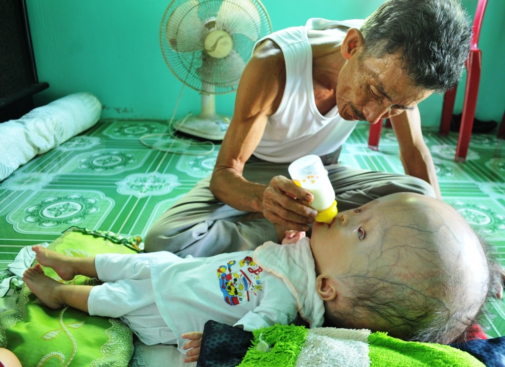 Khốn khổ cuộc sống của bé 14 tháng tuổi có đầu to gấp bốn lần cơ thể - 3 Dù bệnh tật nhưng bé Đạt rất thích nghe nhạc và chỉ thích ông ngoại cho bú sữa bình