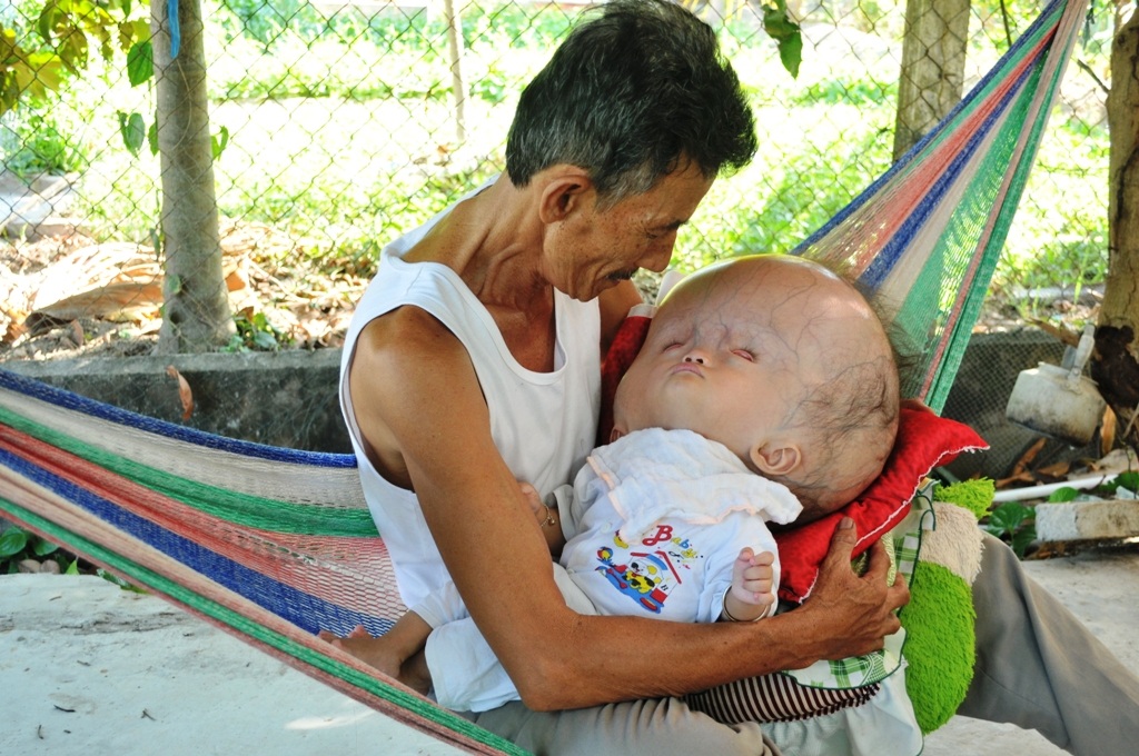 Khốn khổ cuộc sống của bé 14 tháng tuổi có đầu to gấp bốn lần cơ thể - 7 Cháu Anh Thi mong cha và ông bà ngoại có tiền để đưa em Đạt đi chữa bệnh