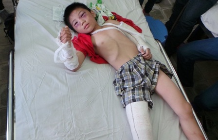 Bé Hiếu đang được chăm sóc tích cực tại khoa Ngoại thần kinh