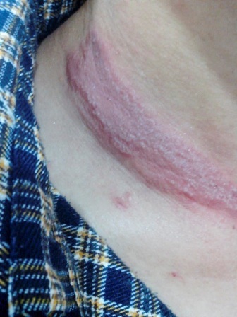 Vết thương để lại trên cổ của một sinh viên sau khi bị kiến ba khoang đốt