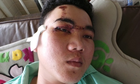 Vết thương trên mặt được anh Hải khẳng định là do dùi cui gây ra.
