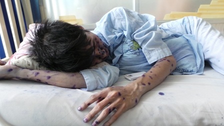 Bệnh nhân mắc thủy đậu điều trị tại bệnh viện Bệnh Nhiệt Đới