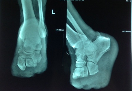 Không biết bản thân bị tiểu đường dẫn tới chủ quan khiến ông T mất nửa bàn chân
