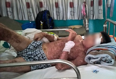 Bệnh nhân bỏng nặng vì dùng xăng nhóm lửa - 1 Chỉ vì sơ ý, bệnh nhân đã bị bỏng nặng
