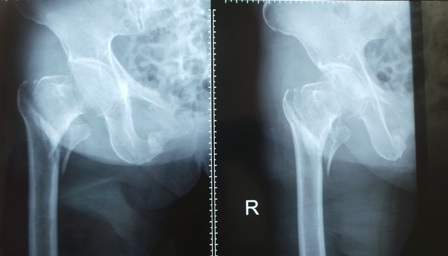 Sau cú ngã, cổ xương đùi phải của bà cụ bị gãy thành nhiều mảnh