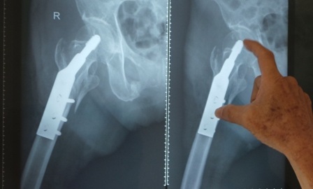 Bác sĩ đã thực hiện thành công ca mổ kết hợp xương nẹp vít trên nền cơ địa nhiều bệnh mạn tính