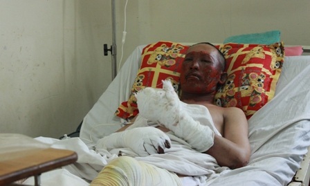 Vụ nổ xảy ra khiến anh Hoàng bị bỏng nặng nhiều vùng trên cơ thể