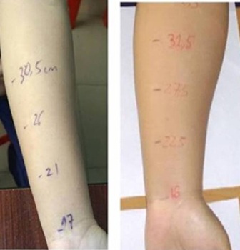 Lần đầu tiên ghép thành công hạch bạch huyết