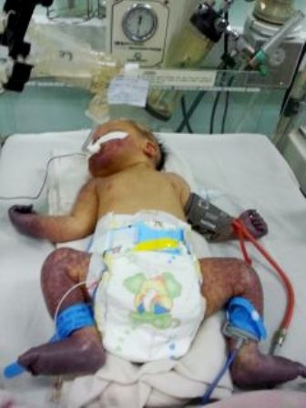 Cứu sống trẻ sơ sinh nhiễm trùng huyết, hoại tử tứ chi - 1 Bệnh nhân tím tái, hoại tử tứ chi khi mới nhập viện