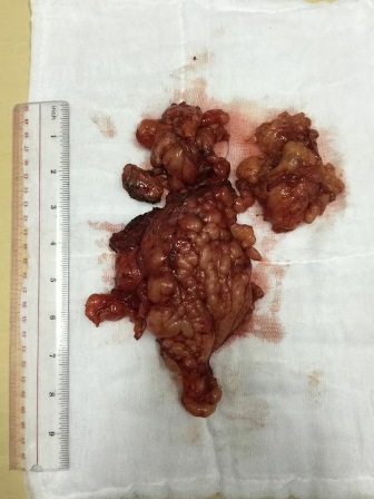 Khối u nặng gần 2kg được bóc thành công, khỏi cơ thể bệnh nhân