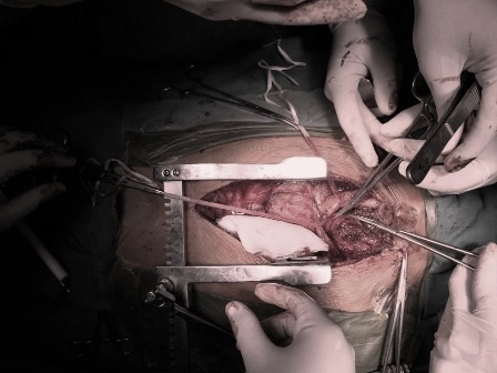 Dạng u sợi thần kinh khổng lồ nằm ở vùng cổ, trung thất của bệnh nhân