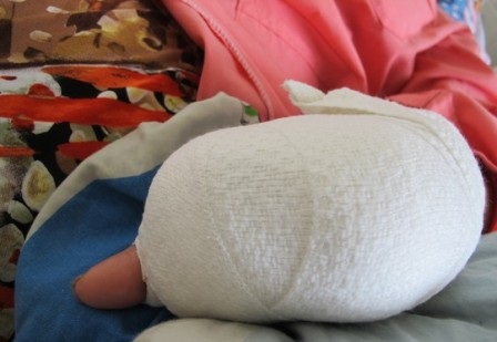 Bàn tay trái của nạn nhân chỉ còn lại duy nhất ngón cái