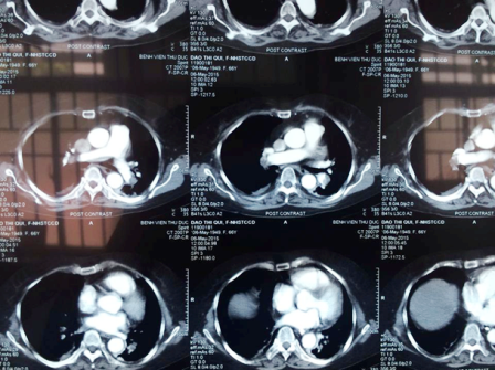 Hình ảnh CT ngực cho thấy, huyết khối gây thuyên tắc hoàn toàn động mạch phổi 2 bên