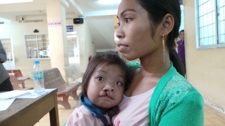 Một cháu bé tại Trà Vinh bị dị tật khe hở môi nhưng mắc bệnh tim nên chưa được can thiệp