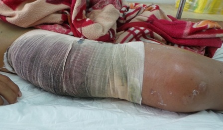 Chân phải của bệnh nhân đang có dấu hiệu phù nề, nhiễm trùng