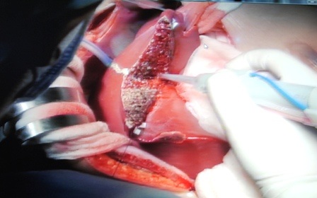 Hình ảnh từ một cuộc ghép gan tại bệnh viện Chợ Rẫy