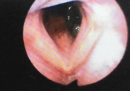 Ho ra máu vì đỉa suối cư ngụ trong cuống họng - 1 Hình ảnh nội soi phát hiện con đỉa cư ngụ trong cuống họng bệnh nhân