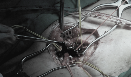 Bệnh nhân được phẫu thuật kết hợp đặt stent tĩnh mạch