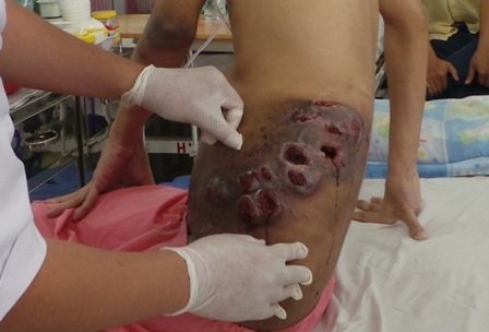 Ổ nhiễm trùng, hoại tử chảy máu lâu cầm gây đau đớn cho người bệnh