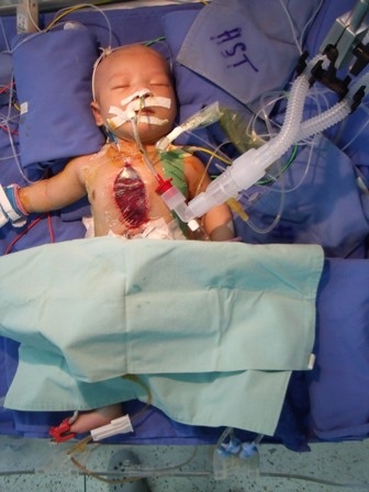 Một bệnh nhi được thực hiện thành công ca phẫu thuật chuyển vị đại động mạch