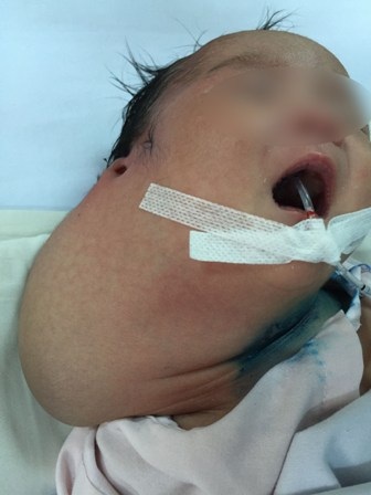 Khối bướu khổng lồ chiếm trọn vùng cổ bé sơ sinh