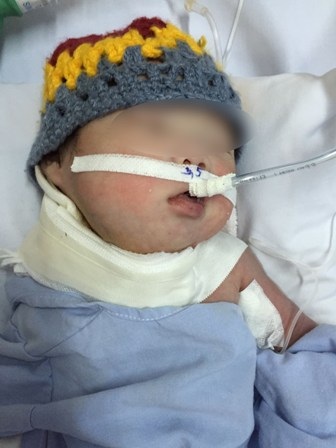 Sau hơn 4 giờ phẫu thuật, bác sĩ đã trả lại hình dạng khuôn mặt cho bệnh nhi