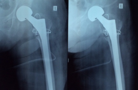 Phẫu thuật thay khớp háng cho người lớn tuổi thường đối mặt với nhiều rủi ro