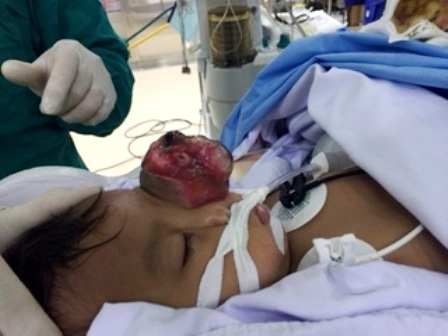 Cấu trúc mắt trái của bệnh nhi bị đẩy lồi ra ngoài 5cm