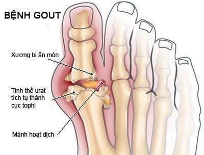 Bệnh Gout hình thành do sự rối loạn chuyển hóa acid uric trong cơ thể