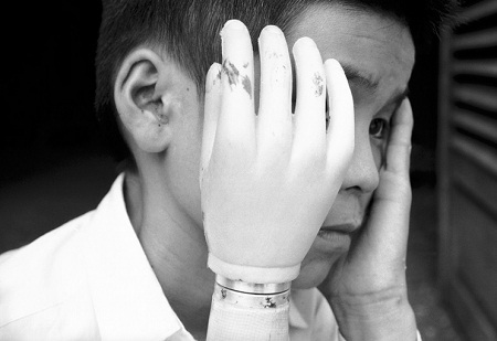 Đau thương chiến tranh qua những bàn tay - 11 Đôi bàn tay không còn
lành lặn của bé thơ.