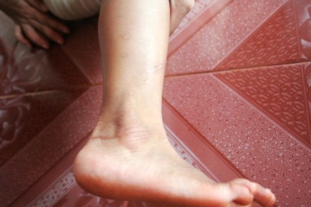 Gặp lại bé gái bất hạnh bị mẹ cắt gân tay, chân - 7