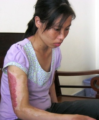 Bị chồng tưới xăng đốt, vợ vẫn viết đơn xin khoan hồng - 1 Bị chồng tưới xăng đốt, vợ vẫn viết đơn xin khoan hồng