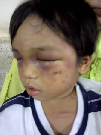 Cháu bé 3 tuổi bị cậu đánh đập dã man, bắt đi ăn xin - 2 Những vết thương chằng chịt trên mặt và khắp thân thể cháu bé 3 tuổi