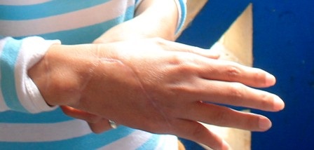 Cận cảnh bàn tay trái của chị Thúy