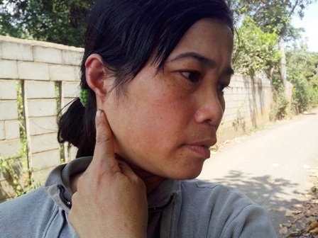 Chị chồng cắn rách tai em dâu giữa chợ vì... 2 triệu đồng - 1 Bà Hoa chỉ vết thương trên vành tai do chị chồng cắn