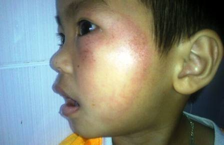 Mẹ của hiệu trưởng trường mầm non dùng dép tát vào mặt trẻ - 1 Cận cảnh vết thương trên mặt cháu Gia Bảo
