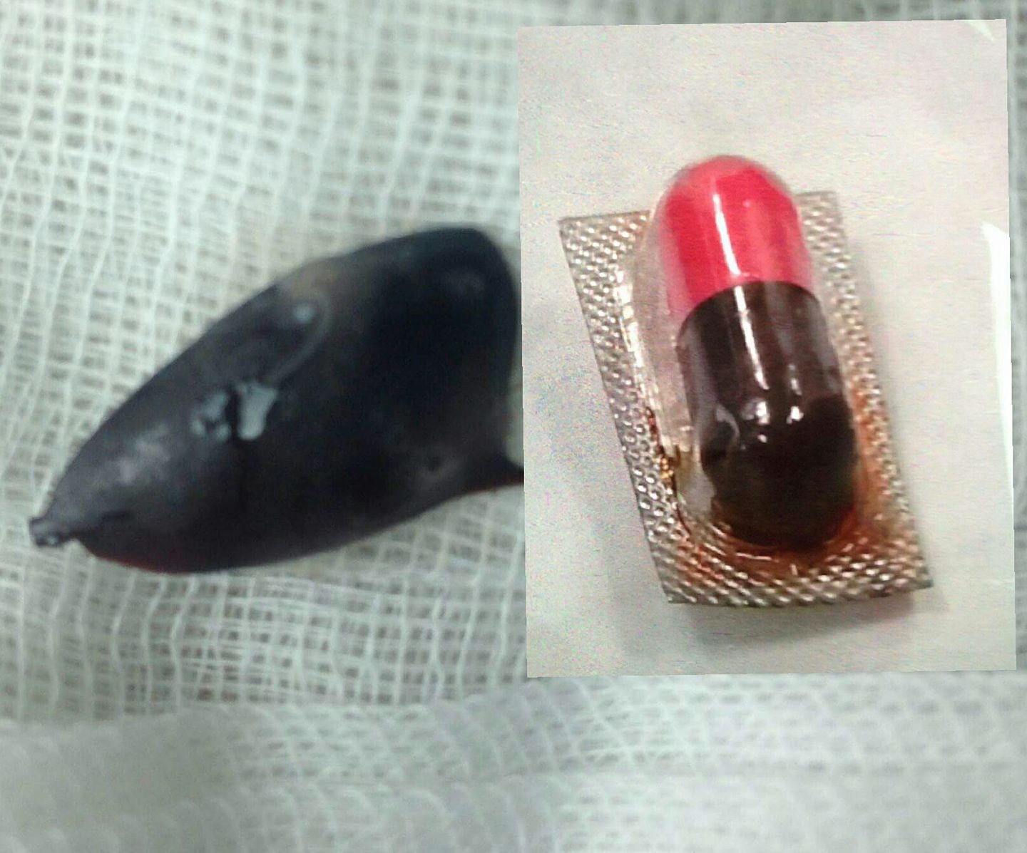 Dị vật là hạt hồng xiêm, viên thuốc con nhộng được lấy ra. Ảnh: BS cung cấp.